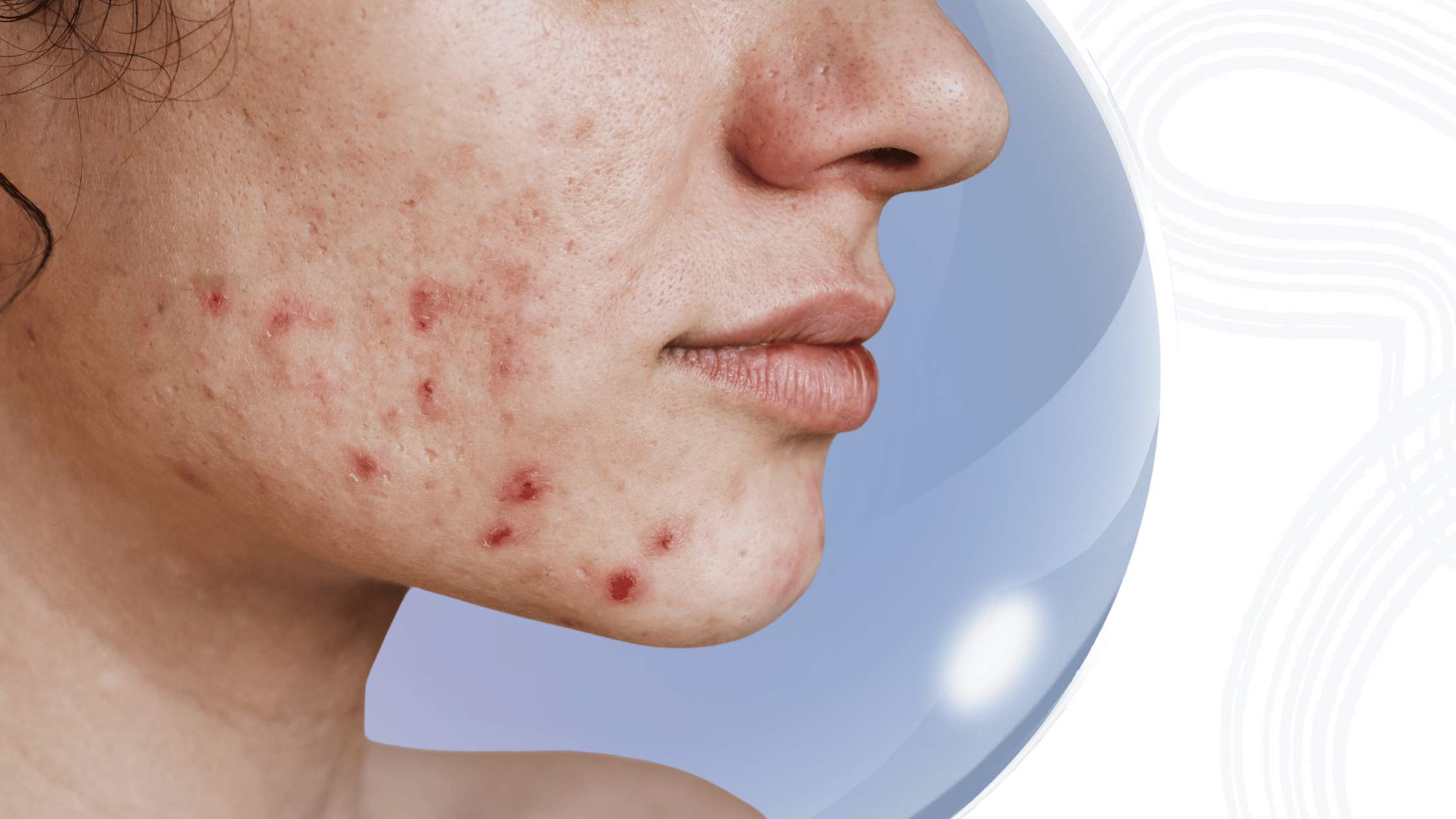 How Becura Combines Lactoferrin, Omega-3, and Vitamins to Fight Acne