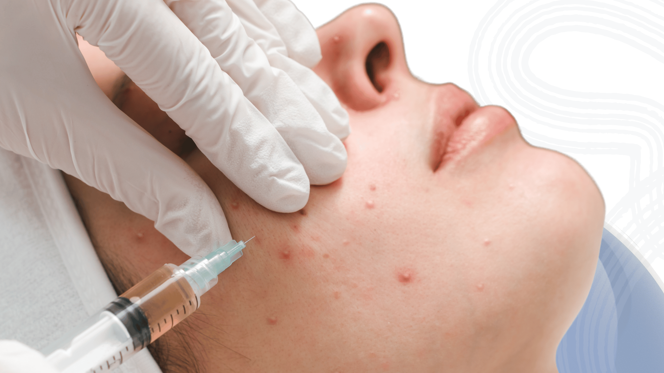 Lactoferrin for Acne