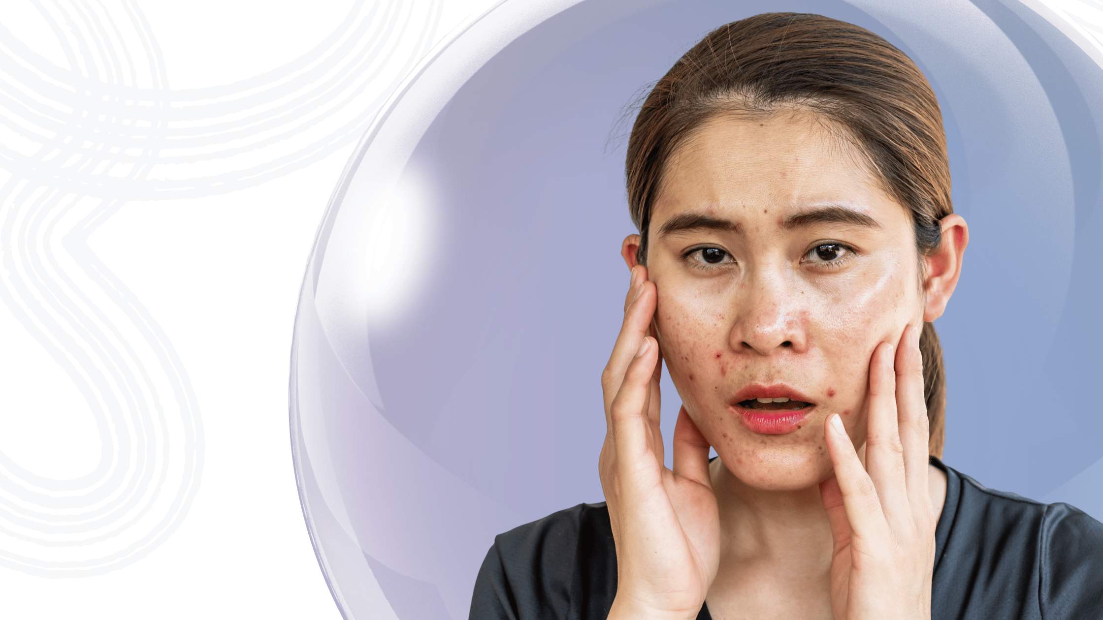 How Supplements Can Help You Control Hormonal Acne